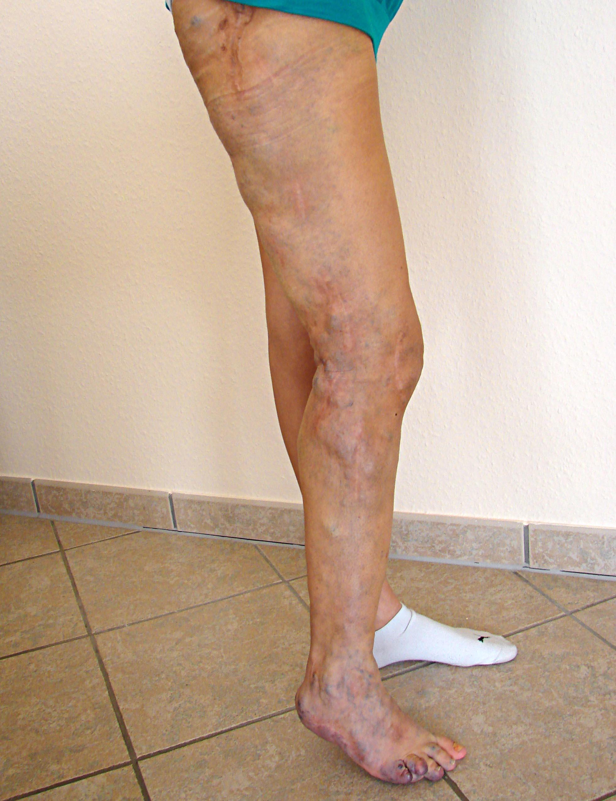 Angeborene Gefäßfehlbildungen (Angiodysplasien) BV Angiodysplasie